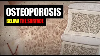 Osteoporosis (Part 2) - Below The Surface