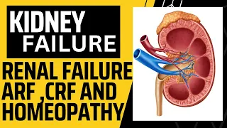 renal failure,kidney failure ||chronic renal failure||kidney failure homeopathic treatment in hindi!