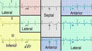 Infarto Agudo del Miocardio con Elevación del Segmento ST