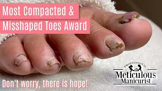 👣How to Pedicure Transformation the Most Compacted & Misshapen Toenails👣