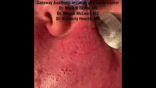 Treatment of pitted acne scars, using a new technique that I developed at Gateway Aesthetic