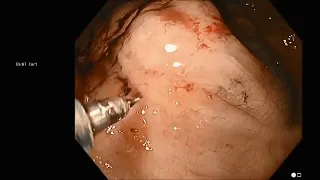 Methods to Inject Endoscopic Tattoo into the Submucosal Space with Dr. Douglas K.  Rex