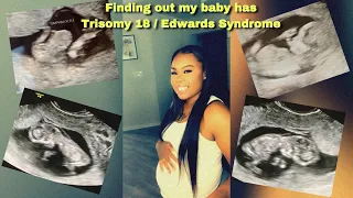 Trisomy 18 | Finding out my baby has Edwards’ Syndrome