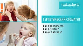 30. Острый герпетический стоматит у детей. Как лечить?