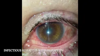 INFECTIOUS KERATITIS WITH HYPOPYON