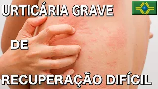 URTICÁRIA GRAVE DE RECUPERAÇÃO DIFÍCIL | Quais os tipos e Como definir um diagnóstico?