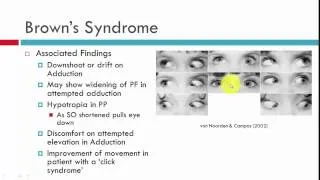 Brown's Syndrome Clinical Characteristics