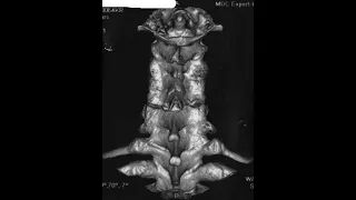 Forestier's disease, хороба Форестьє, анкілозуючий спонділоартроз (в російській версії Бехтерева)