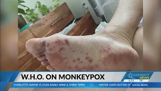 Monkeypox cases grow in NC