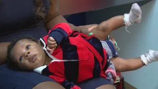 Baby absorbs twin, carries birthmark resembling his sister