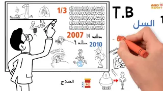 Tuberculosis ( Types, causes, Pathogenesis, Diagnosis, treatment )