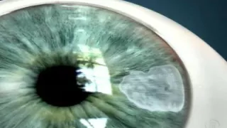 Tratamentos para glaucoma