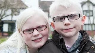 Albino Kids Won't Let Their Condition Hold Them Back