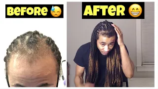 Dreadlock Hair Regrowth Update (Alopecia Update 2)