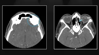 Orbital Trauma | Interesting Radiology Cases