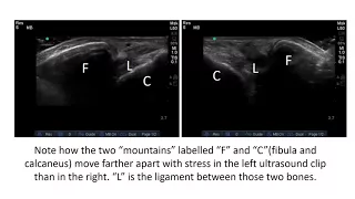 Ankle Stress Exam of Ankle Ligaments