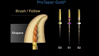 Canal preparation with ProTaper Gold® | Dentsply Sirona