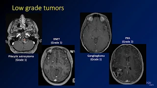 Imaging brain tumors - 4 - Other low grade gliomas