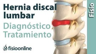 Hernia discal lumbar - Diagnóstico, consejos, ejercicios y tratamiento de fisioterapia