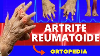 ARTRITE REUMATOIDE - CAUSAS, SINTOMAS, DIAGNÓSTICO E TRATAMENTO - ORTOPEDIA