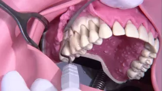 Cirugía periodontal (Colgajo de Widman)