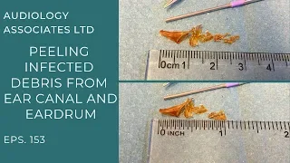 PEELING INFECTED DEBRIS FROM EAR CANAL AND EARDRUM - EP153