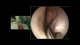 Anterior skull base dissection ( Cadaver 1 ) - Dr. Satish Jain - www.skullbase360.in