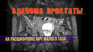 АДЕНОМА ПРОСТАТЫ и гиперплазия предстательной железы на РАСШИФРОВКЕ МРТ органов малого таза