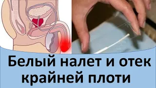 Белый налет и отек крайней плоти