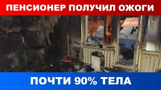 Пенсионер получил ожоги почти 90% тела при пожаре в Лиозно