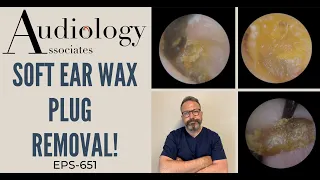 SOFT EAR WAX PLUG REMOVAL - EP651