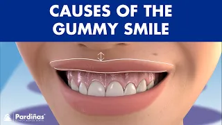 Causes of GUMMY SMILE - Do you show a lot of GUM when you SMILE? ©