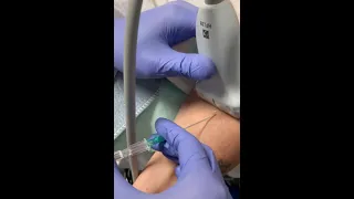 Ultrasound guided IV placement. 3/2021