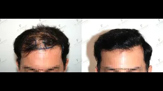 Haartransplantation mit FUE 8618 Grafts in 2 Operationen - deutsch