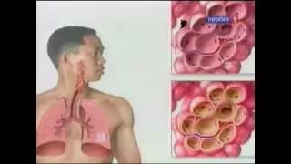 Пневмония воспаления легких - признаки, симптомы и лечение