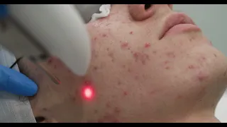 Fotona Laser Acne Treatment