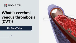 What is cerebral venous sinus thrombosis (CVST)?