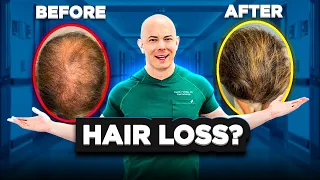 Oral Minoxidil For Hair Loss? What You Need to Know