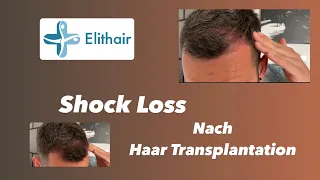 Shock Loss nach Haartransplantation + 12 Wochen Update.