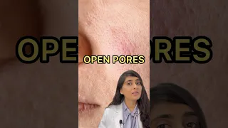 Open pores | How to get rid of pores on face | Large pores