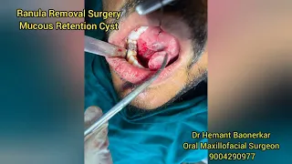 Ranula Surgery