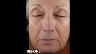 Reno NV Laser Skin Resurfacing Before & After | Avance Plastic Surgery Institute | Dr. Erez Dayan