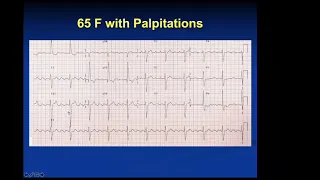 ECGs