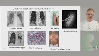 Kurzvorstellung der systemischen Sklerose (Sklerodermie)