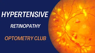 Hypertensive Retinopathy