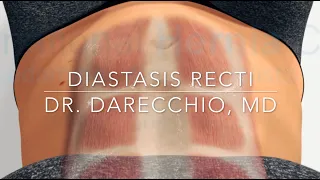 Does Diastasis Recti exercises really close the GAP | Dr. Darecchio