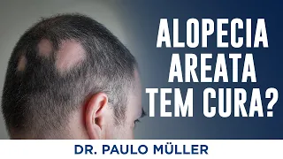 Alopecia Areata tem cura? - Dr. Paulo Müller Dermatologista