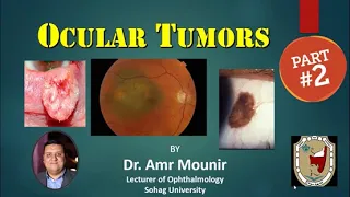 Ocular Tumor part 2