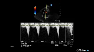 How to... Measure LVOT Obstruction