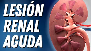 Lesión Renal Aguda Explicada Claramente